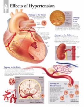 Paperback Effects of Hypertension Chart: Laminated Wall Chart Book