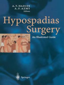 Paperback Hypospadias Surgery: An Illustrated Guide Book