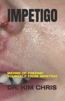 Paperback Impetigo: Means of Freeing Yourself from Impetigo Book