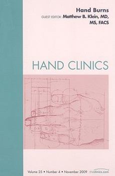 Hand Burns