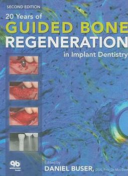 Hardcover 20 Years of Guided Bone Regeneration in Implant Dentistry Book