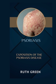 Paperback Psoriasis: Exposition of the Psoriasis Disease Book