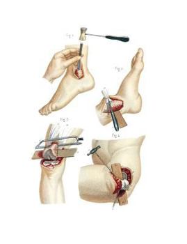 Paperback Resections Performed on the Lower Extremity Composition Notebook: Wide Ruled Note-Taking Book