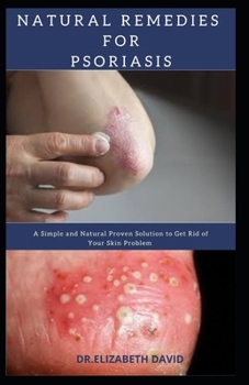 NATURAL REMEDIES FOR PSORIASIS: A Simple and Natural Proven Solution to Get Rid of Your Skin Problem : Dermatitis, Eczema, Psoriasis & Rosacea and Others