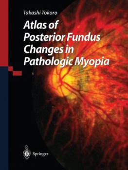 Paperback Atlas of Posterior Fundus Changes in Pathologic Myopia Book
