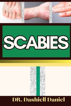 Paperback Scabies: Expert Guide To Understanding Scabies Causes, Symptoms, Preventing, Treatment for optimal wellness Book