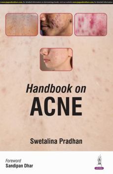 Paperback Handbook on Acne Book