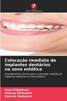 Colocação imediata de implantes dentários na zona estética: procedimentos clínicos para a colocação imediata de implantes dentários na zona estética (Portuguese Edition) B0CJXH1JSD Book Cover