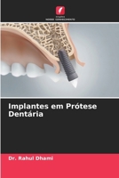 Implantes em Prótese Dentária (Portuguese Edition) 6207674685 Book Cover
