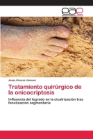 Tratamiento Quirurgico de La Onicocriptosis 3659007536 Book Cover