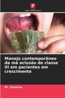 Manejo contemporâneo da má oclusão de classe III em pacientes em crescimento (Portuguese Edition) 6208551668 Book Cover