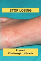Stop Losing: Prevent Cholinergic Urticaria: Losing Itchy Hair B092L3L8NB Book Cover