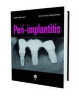 Peri-Implantitis 291255098X Book Cover