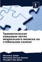 Травматическая ковшовая петля медиального мениска на стабильном колене 6204047906 Book Cover