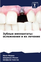 Зубные имплантаты: ослож 6205760282 Book Cover