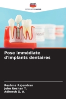 Pose immédiate d'implants dentaires (French Edition) 6208299810 Book Cover