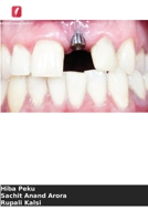 Considerações sobre os tecidos moles em torno do implante imediato 6205321769 Book Cover