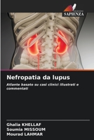 Nefropatia da lupus 6204100513 Book Cover