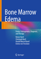 Bone Marrow Edema: Forms, Pathogenesis, Diagnosis, and Therapy 3662723204 Book Cover
