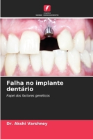 Falha no implante dentário (Portuguese Edition) 6207139682 Book Cover