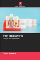 Peri-implantite 6205642581 Book Cover