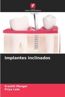Implantes inclinados (Portuguese Edition) 6207792882 Book Cover