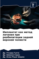 Имплантат как метод лечения при реабилит&#1072 6204032402 Book Cover