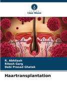 Haartransplantation (German Edition) 6206994937 Book Cover