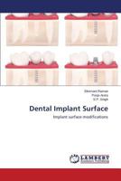 Dental Implant Surface: Implant surface modifications 3659594326 Book Cover
