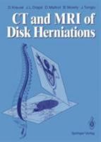 Computed Tomography and Magnetic Resonance Imaging of Disc Herniations 3540191631 Book Cover