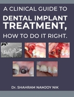 A guide to dental implant treatment, how to do it right. 1968615547 Book Cover