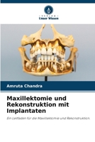 Maxillektomie und Rekonstruktion mit Implantaten (German Edition) 6200080313 Book Cover