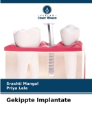 Gekippte Implantate (German Edition) 620779303X Book Cover
