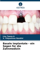 Basale Implantate - ein Segen für die Zahnmedizin (German Edition) 6206834662 Book Cover