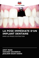 La Pose Immédiate d'Un Implant Dentaire 620321647X Book Cover