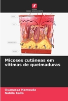 Micoses cutâneas em vítimas de queimaduras (Portuguese Edition) 6208944201 Book Cover