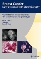 Crushed Stone-like Calcifications: The Most Frequent Malignant Type (Breast Cancer - Early Detection With Mammography) 3131485310 Book Cover