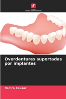 Overdentures suportadas por implantes 6206243079 Book Cover