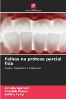 Falhas na prótese parcial fixa (Portuguese Edition) 6630039467 Book Cover