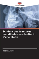 Schéma des fractures mandibulaires résultant d'une chute (French Edition) 6207782070 Book Cover