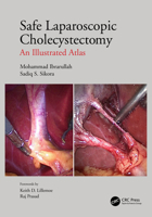 Safe Laparoscopic Cholecystectomy: An Illustrated Atlas 1032005203 Book Cover