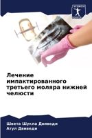 Лечение импактированно&# 6205281589 Book Cover