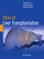 Atlas of Liver Transplantation 303185263X Book Cover