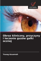 Obraz kliniczny, przyczyny i leczenie guzów galki ocznej (Polish Edition) 6208315603 Book Cover