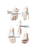 Amputations in the Continuity of the Bones Composition Notebook: Wide Ruled Note-Taking Book 1719881243 Book Cover