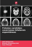 Fístulas carotídeo-cavernosas bilaterais espontâneas 6630334116 Book Cover