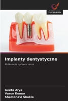 Implanty dentystyczne: Potknięcia i przeoczenia 6202855487 Book Cover