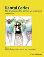 Dental Caries: The Disease and Its Clinical Management 1405107189 Book Cover