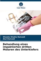 Behandlung eines impaktierten dritten Molaren des Unterkiefers 6205281538 Book Cover